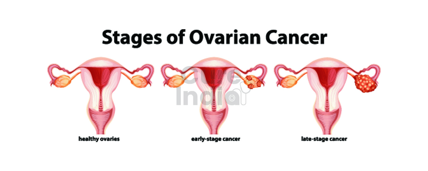 Ovarian Cancer